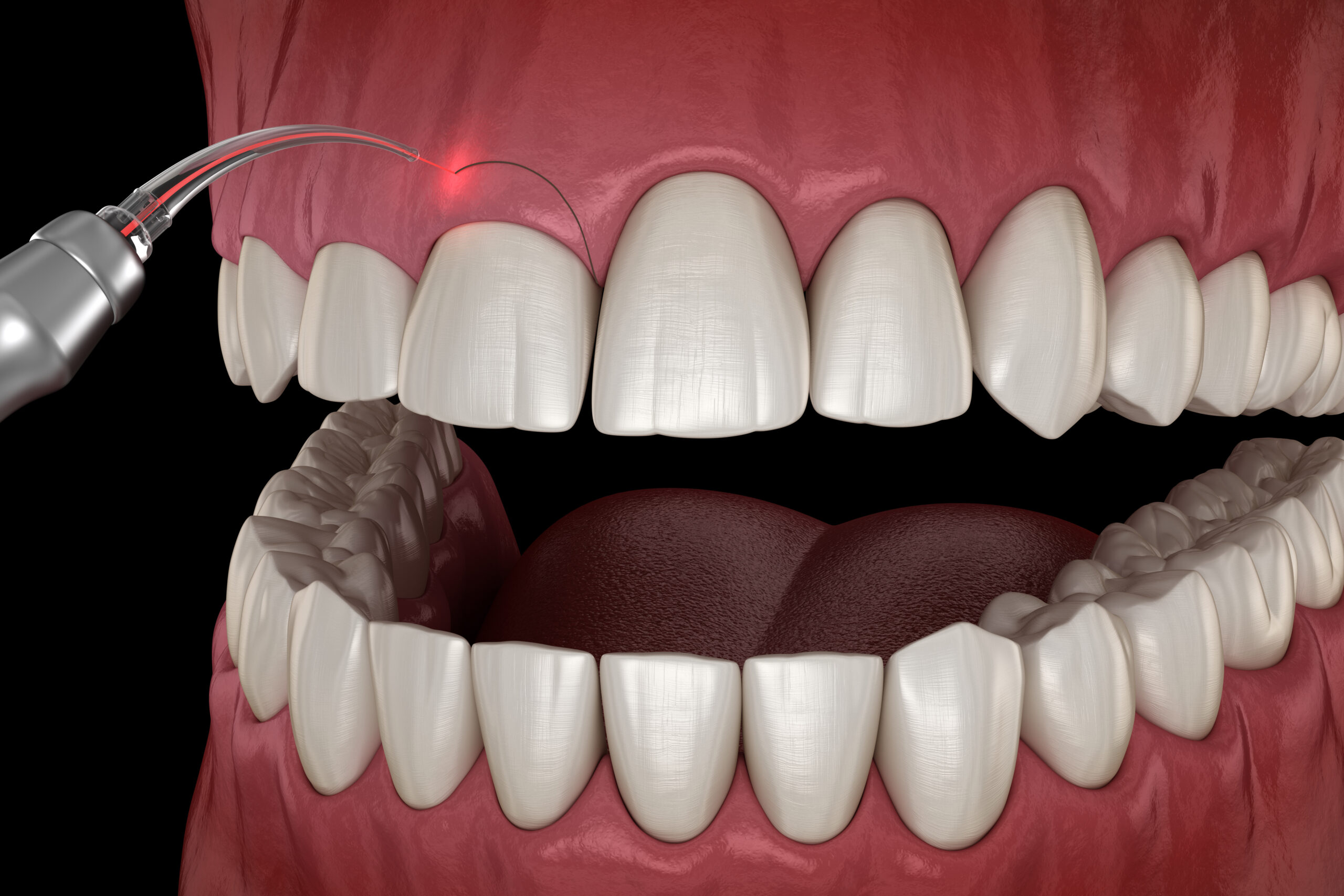 What Is The Purpose Of Gum Contouring?