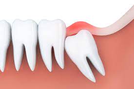 When Do You Need To Get Your Wisdom Tooth Removed By An Edmonton Dentist?