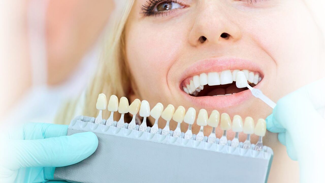 The Purpose Of Tooth-Coloured Fillings