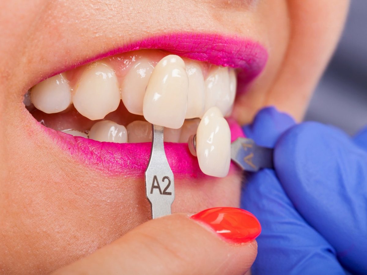 Are Porcelain Veneers Strong