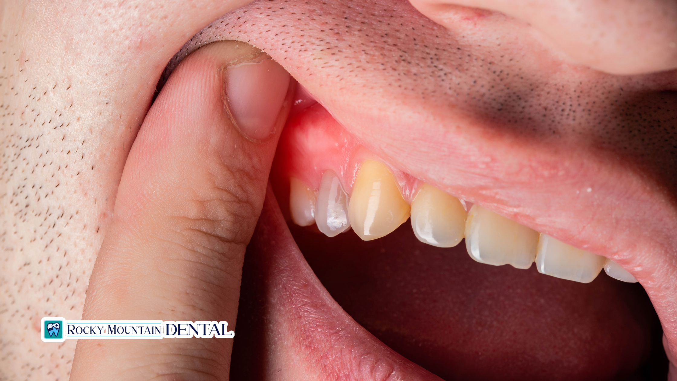 How to Deal with Sore Gums After a Dental Cleaning