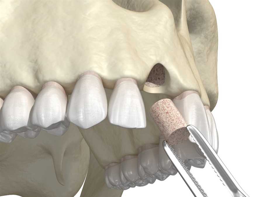 Bone Grafting for Dental Implants Offered In Banff