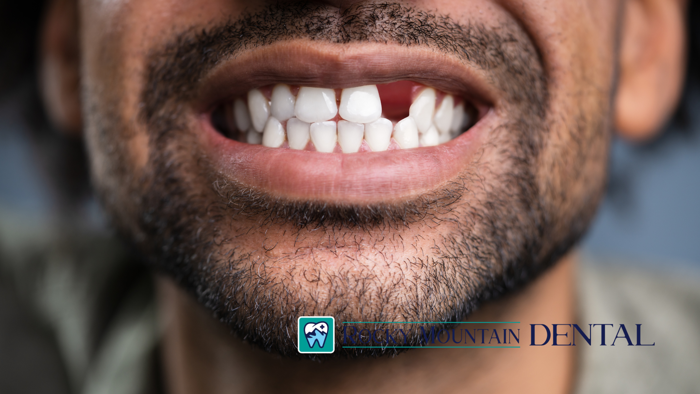How Missing Teeth Affect Your Speech and Facial Structure