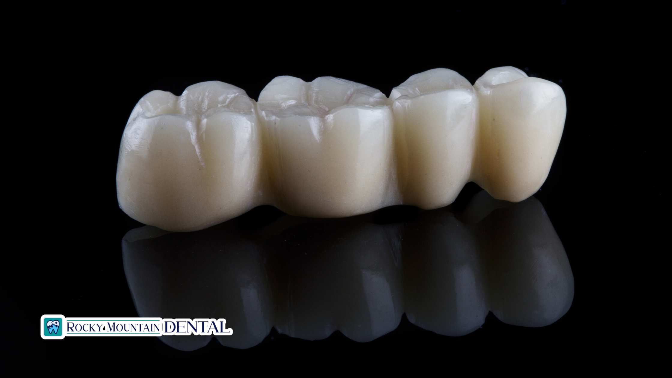 How Long Does a Dental Bridge Last