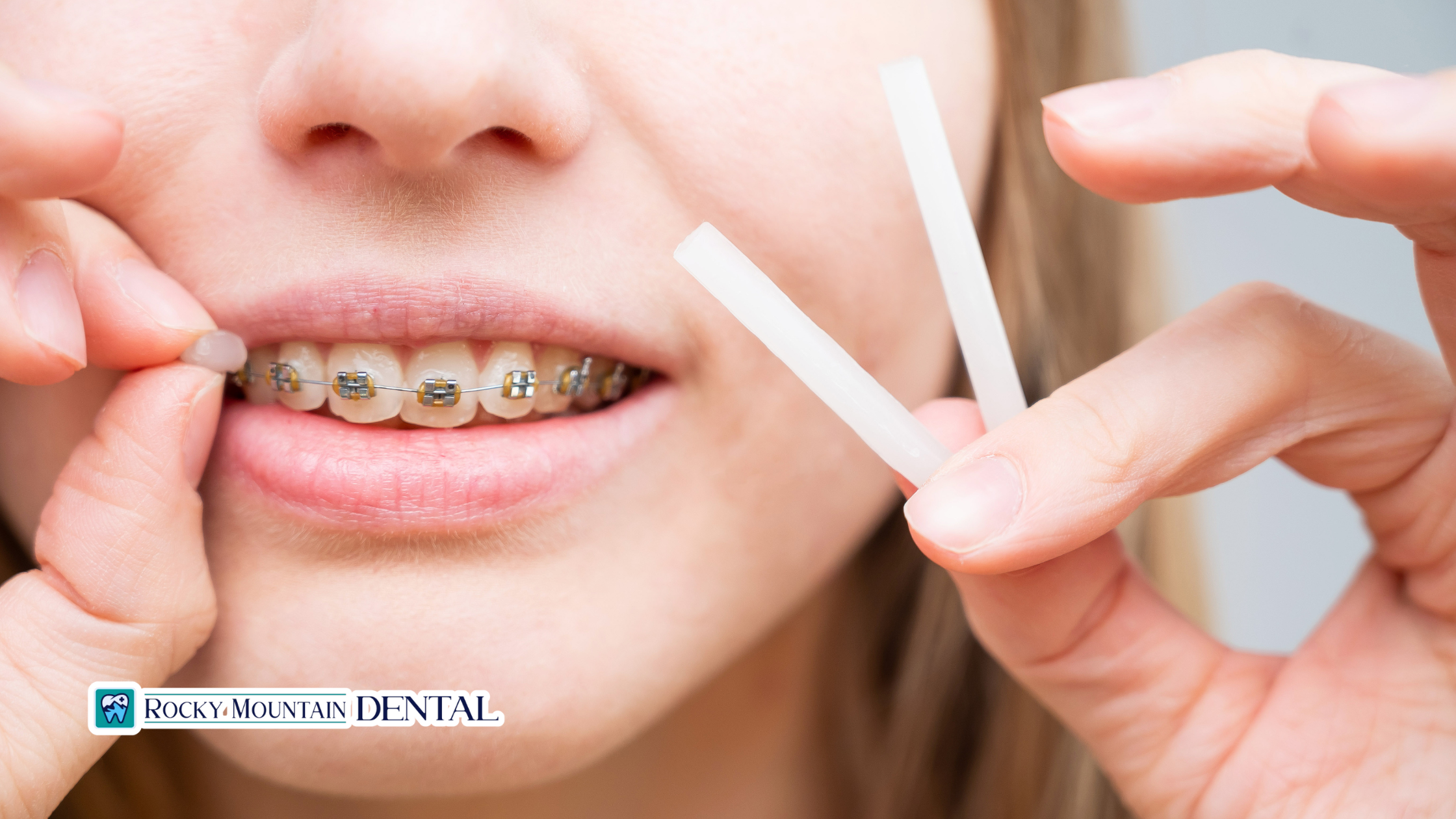 The Benefits of Dental Wax for Braces Discomfort