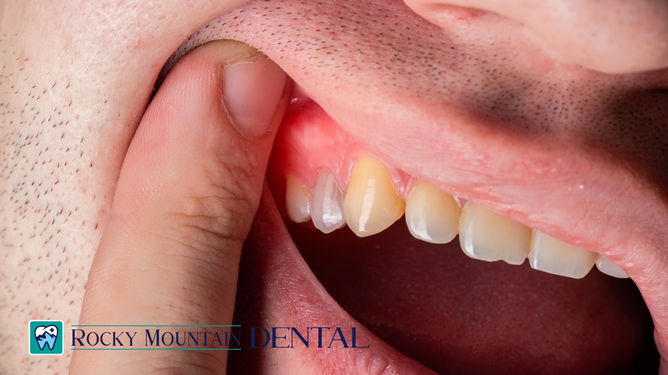 How to Reduce Inflammation in the Gums Naturally