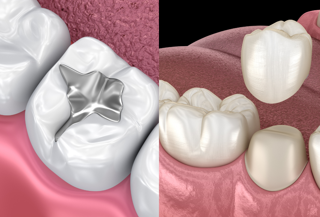 Dental Crown vs. Dental Filling: Which Is the Right Choice for You?