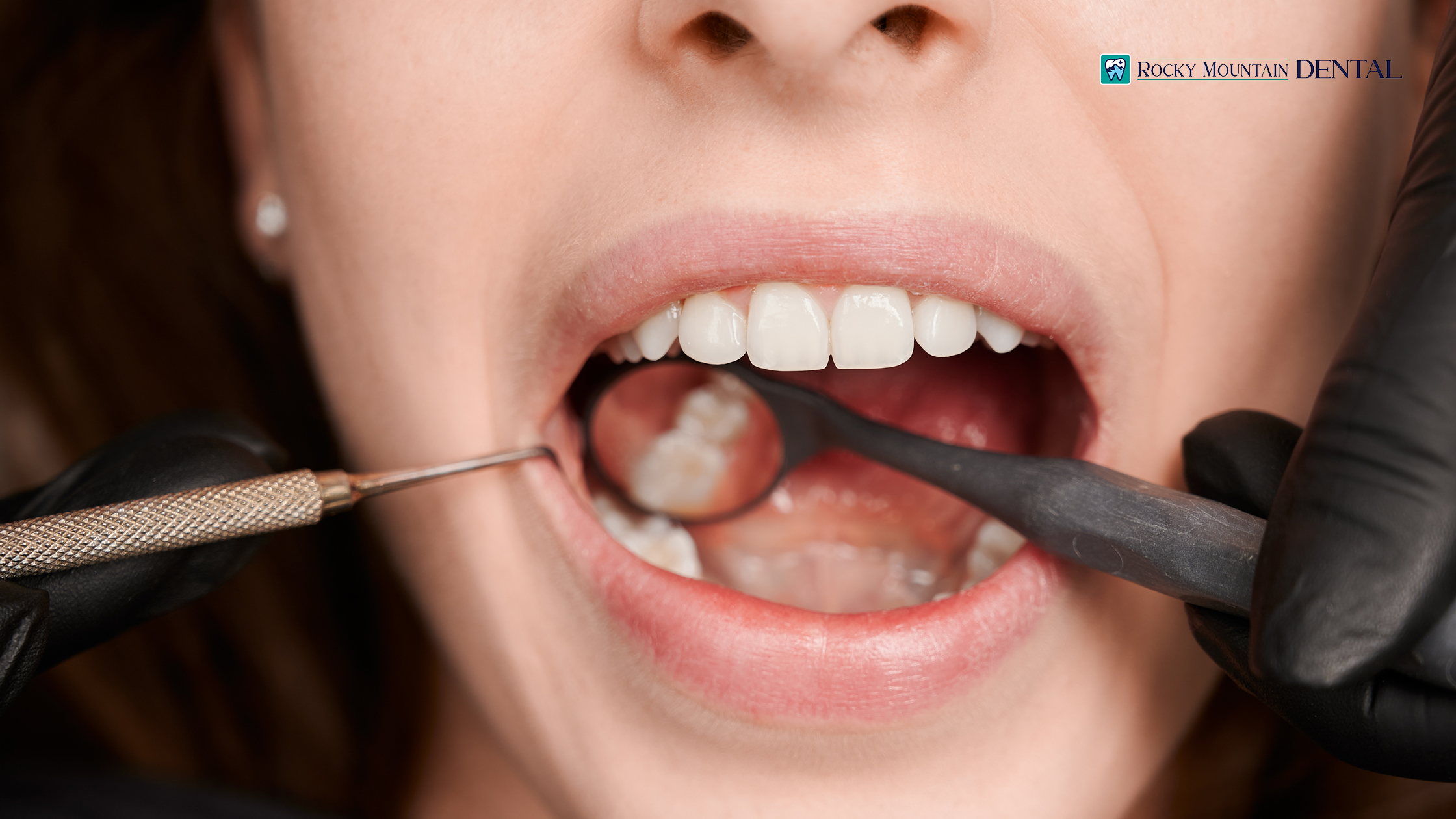 Rocky Mountain Dental’s Guide to a Cavity-Free Christmas in Banff