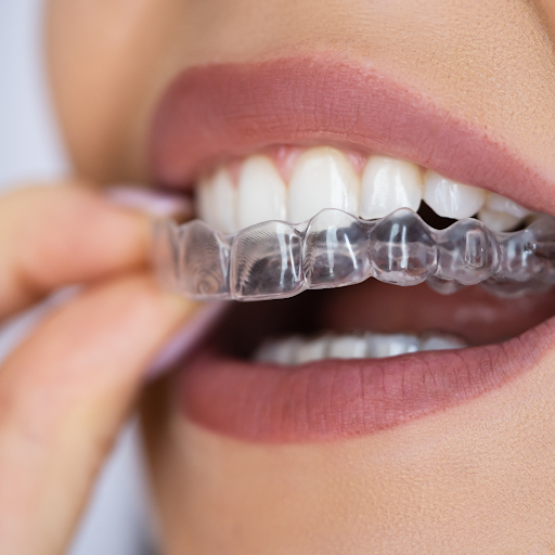 SureSmile Aligners for Overbites and Underbites: Correcting Jaw Alignment