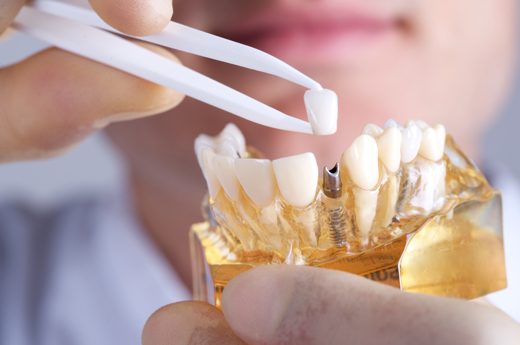 Exploring Dental Implants: Is It the Right Choice for You?