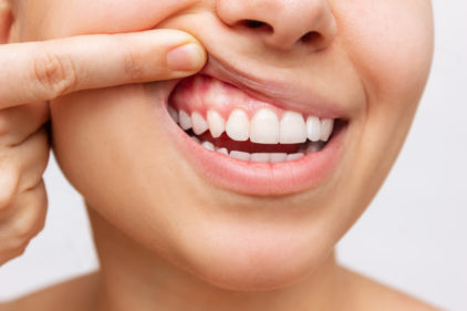 Gum Contouring: The Solution to Your Gummy Smile
