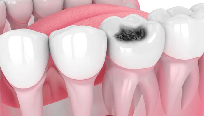 The Impact of Dry Mouth on Cavities