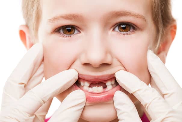 Kids And Cavities: The Secret To Your Child’s Oral Health
