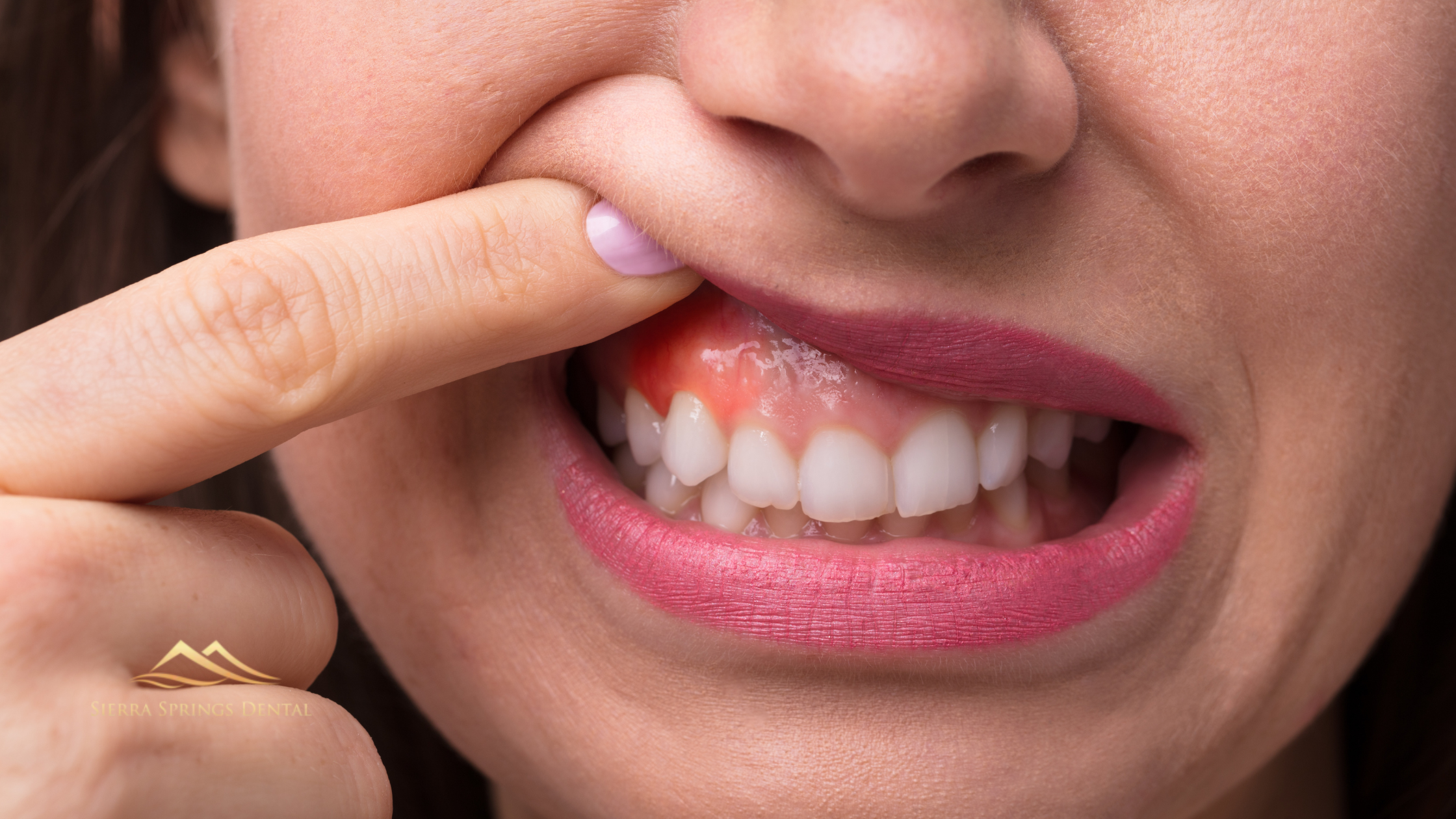 Can Receding Gums Be Reversed with Non-Surgical Options