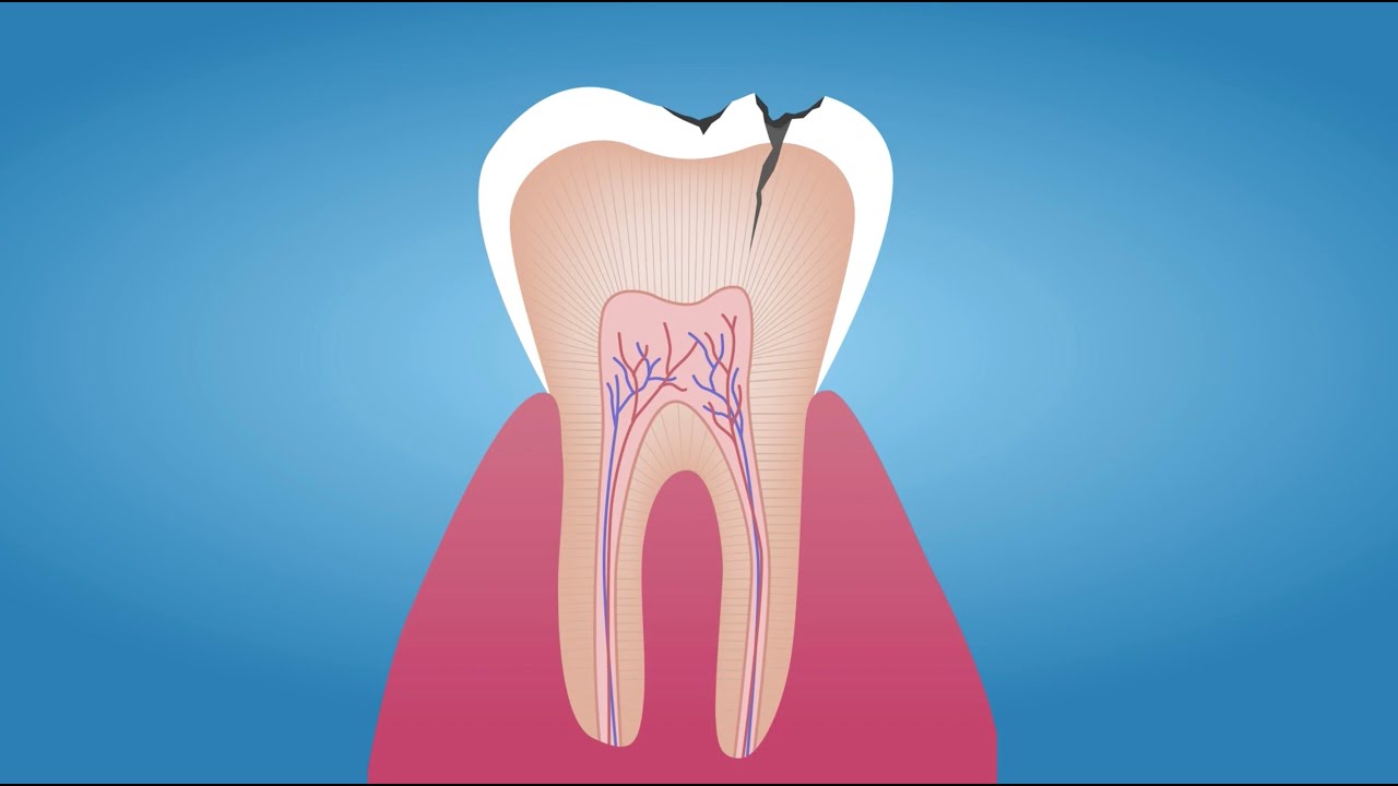 What Are The 4 Causes Of Tooth Decay?