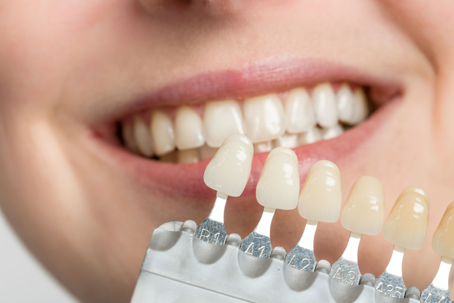 What You Need To Know About Dental Composite Bonding
