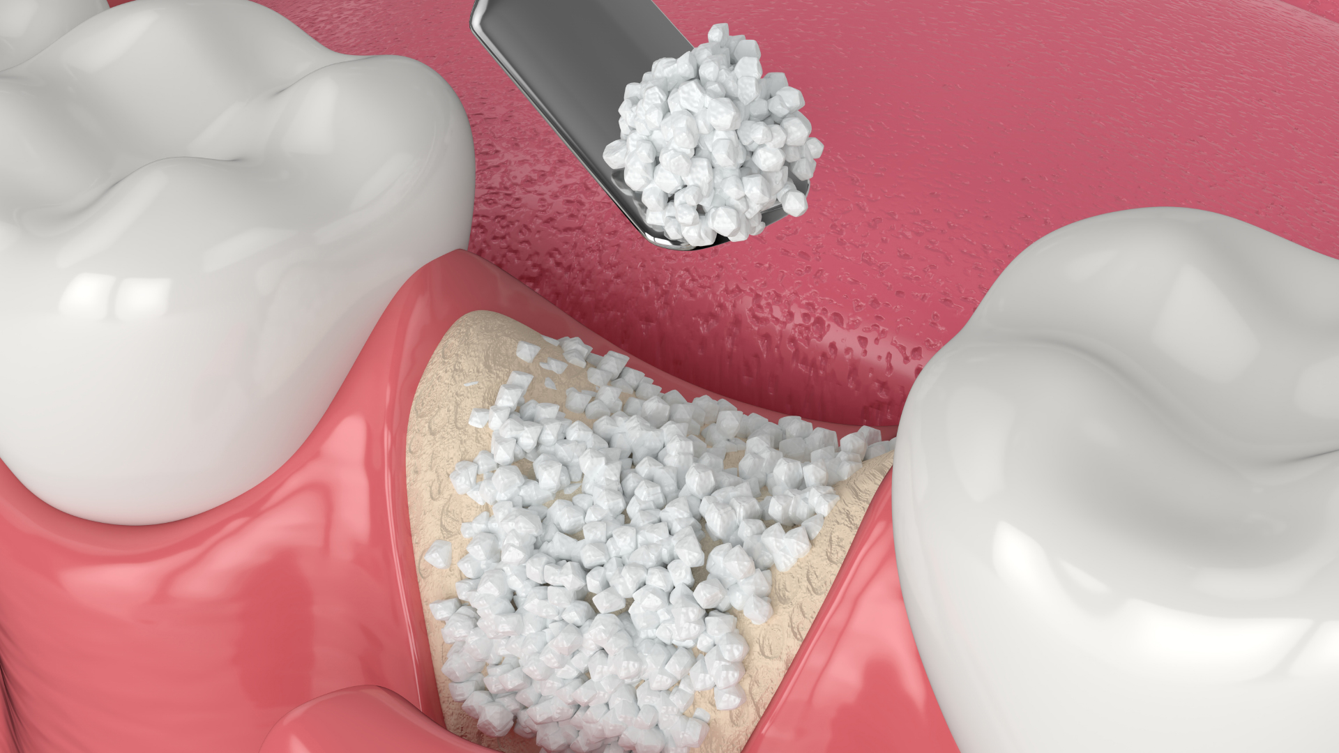 Is Dental Bone Grafting Safe?