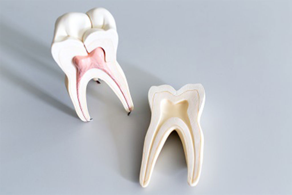 Reasons for Root Canal Therapy