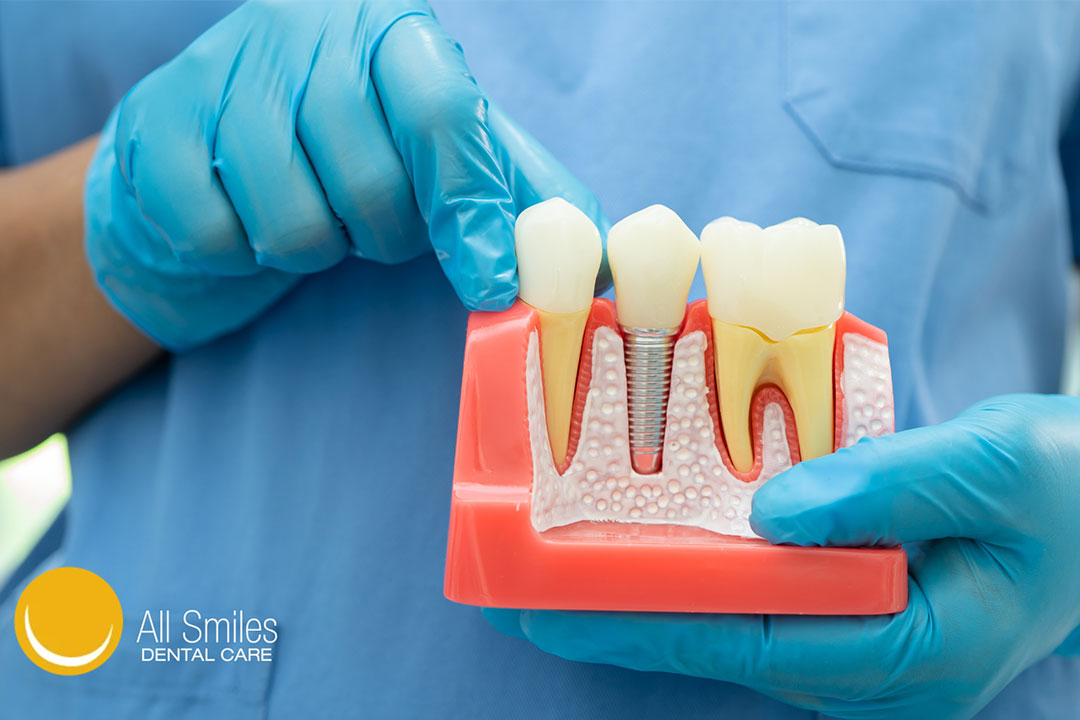 How to Care for Your Dental Implants