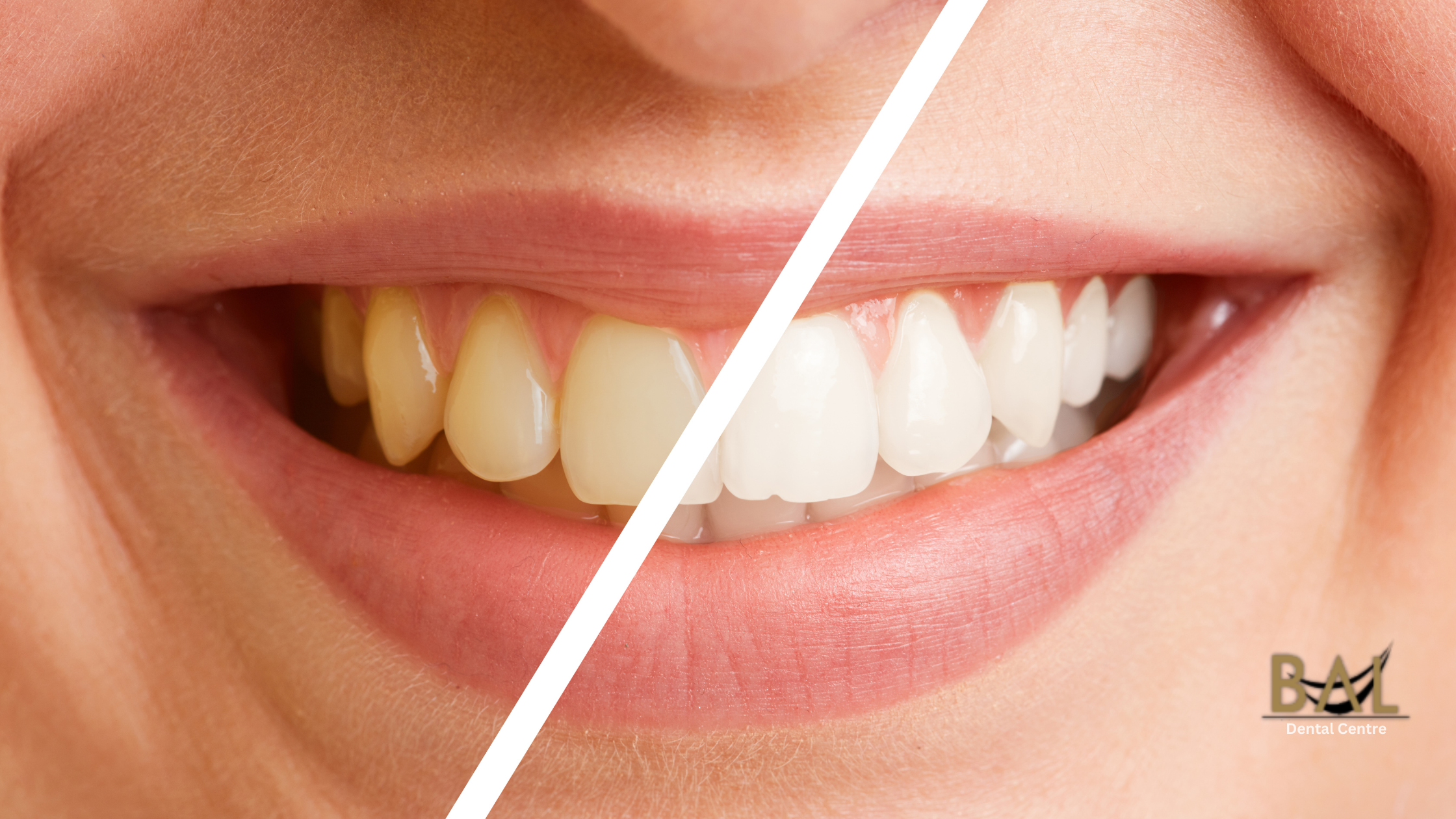 How to Tell the Difference Between Tartar and Stains