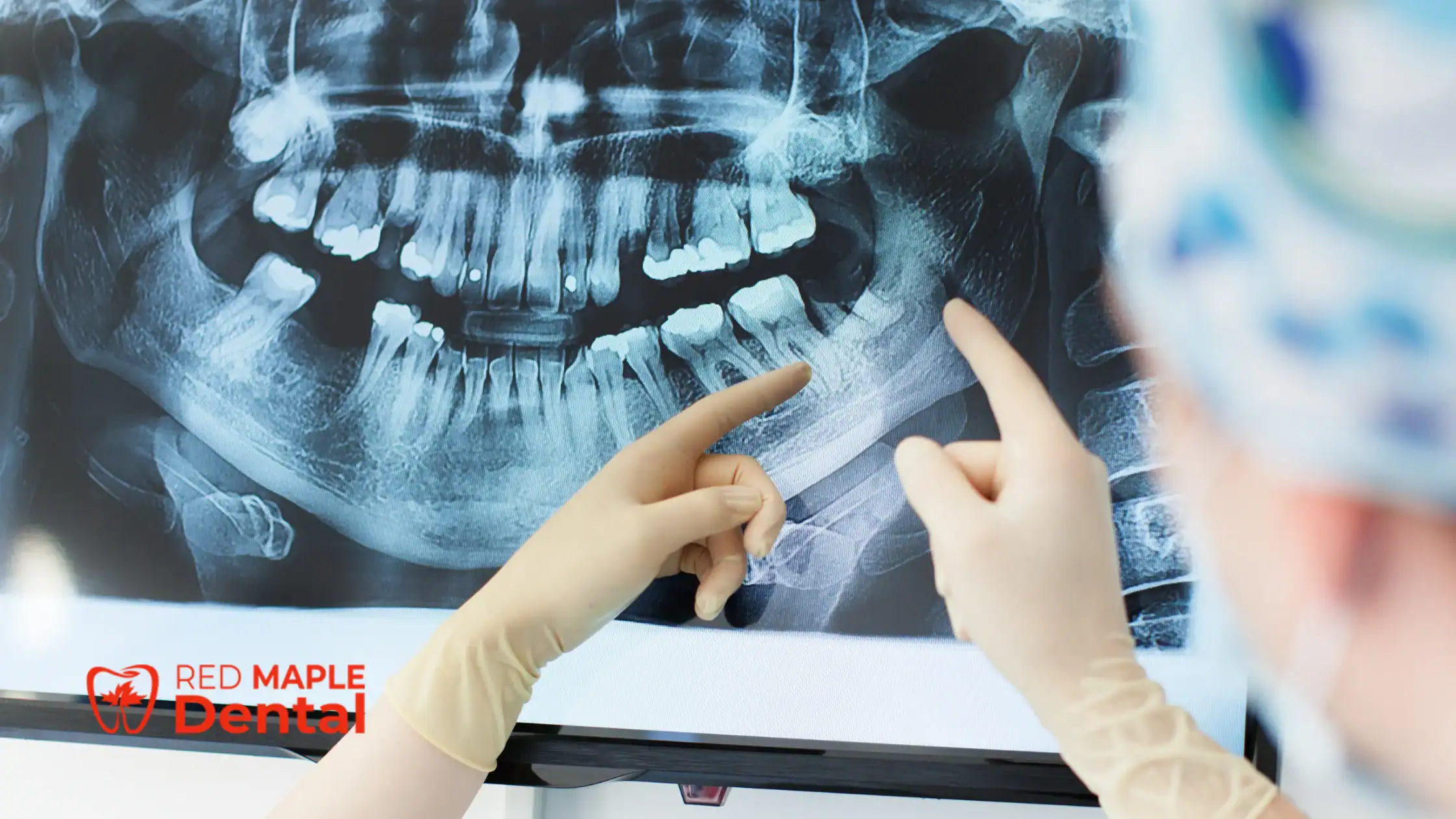How Often Should Seniors Get Dental X-rays