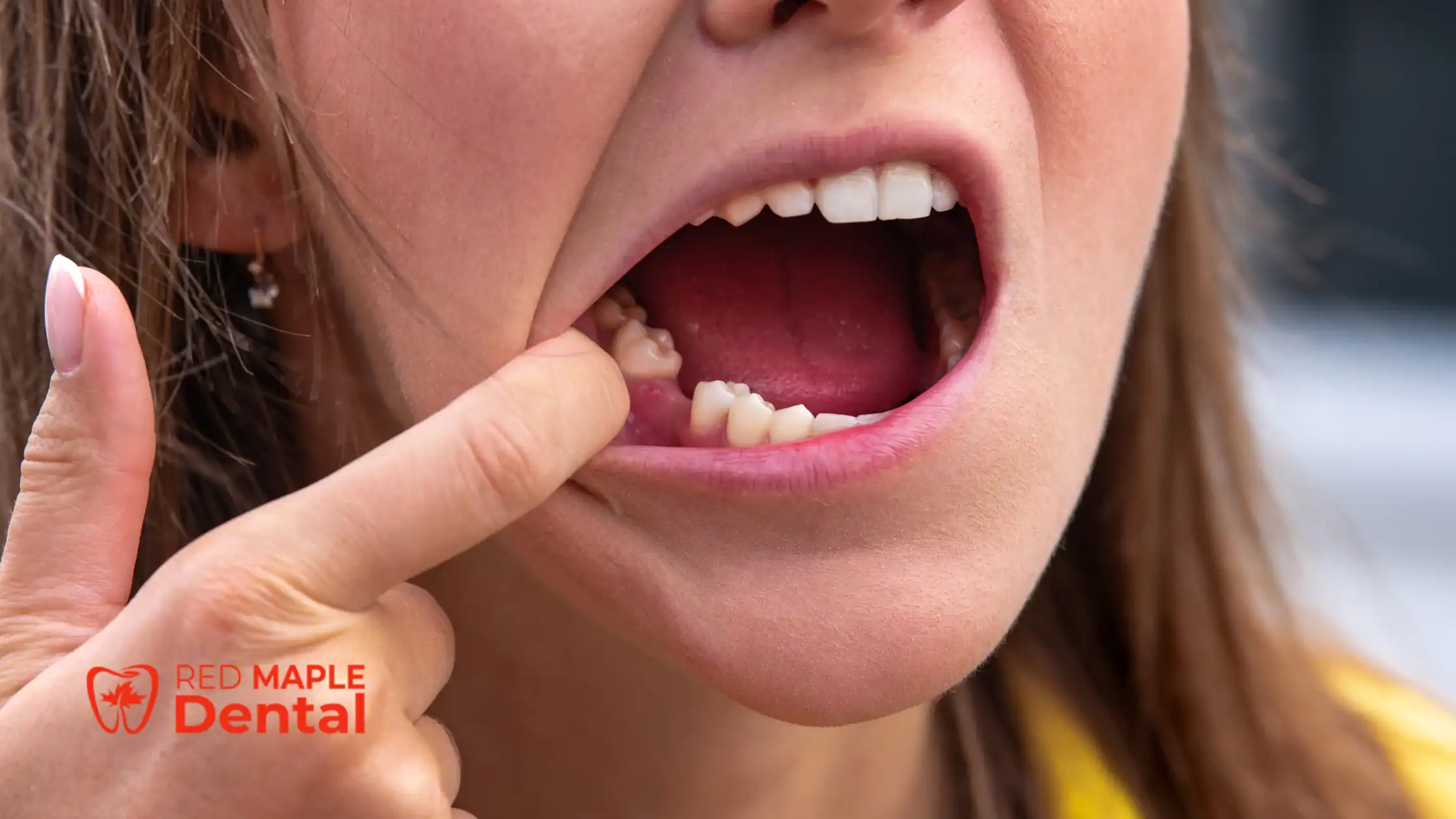 How to Treat a Dry Socket After Tooth Removal