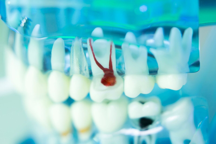 5 Questions About Root Canal Treatments, Answered