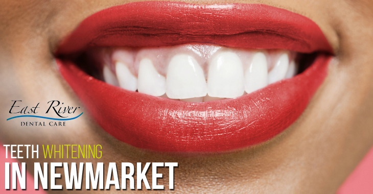 Benefits of Visiting a Teeth Whitening Clinic