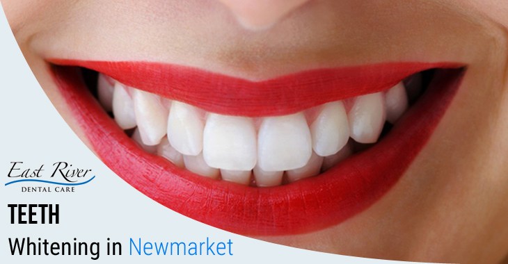 Visiting a Teeth Whitening Clinic Newmarket