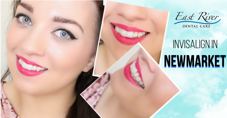 Does Invisalign Hurt a Lot?