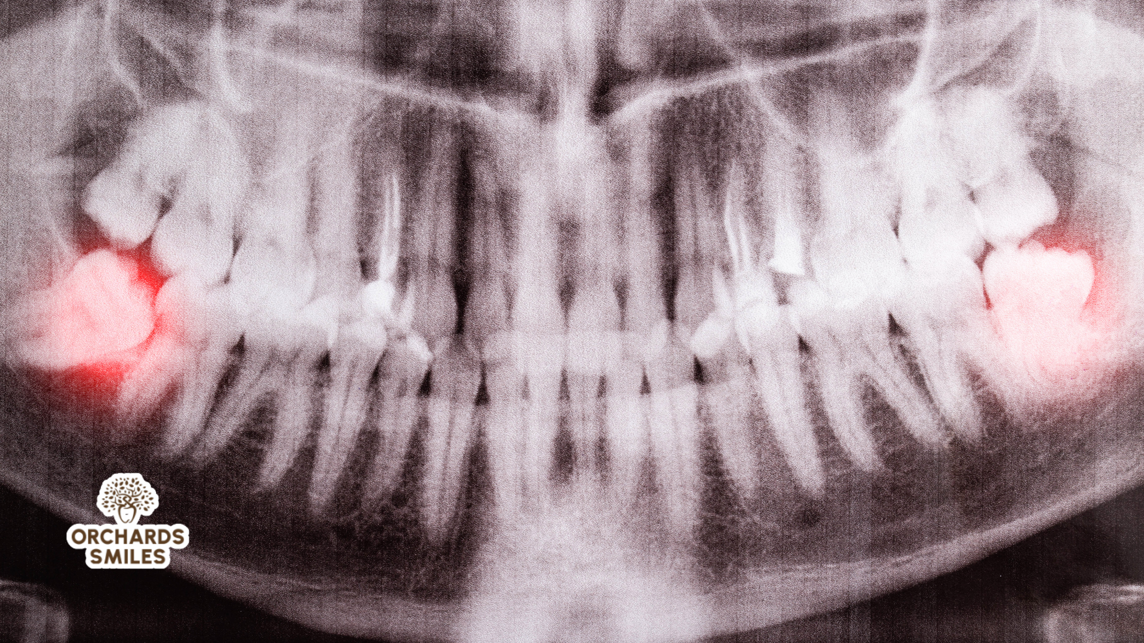 When Do Wisdom Teeth Actually Require Removal
