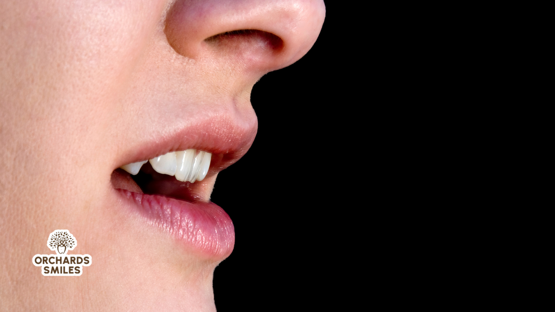 The Connection Between Mouth Breathing and Tooth Decay