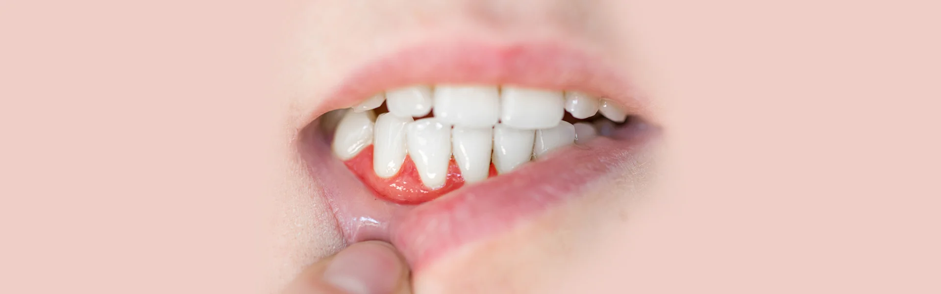 Irritated gums making it perfect candidate for gum graft by a dentist in Ajax.