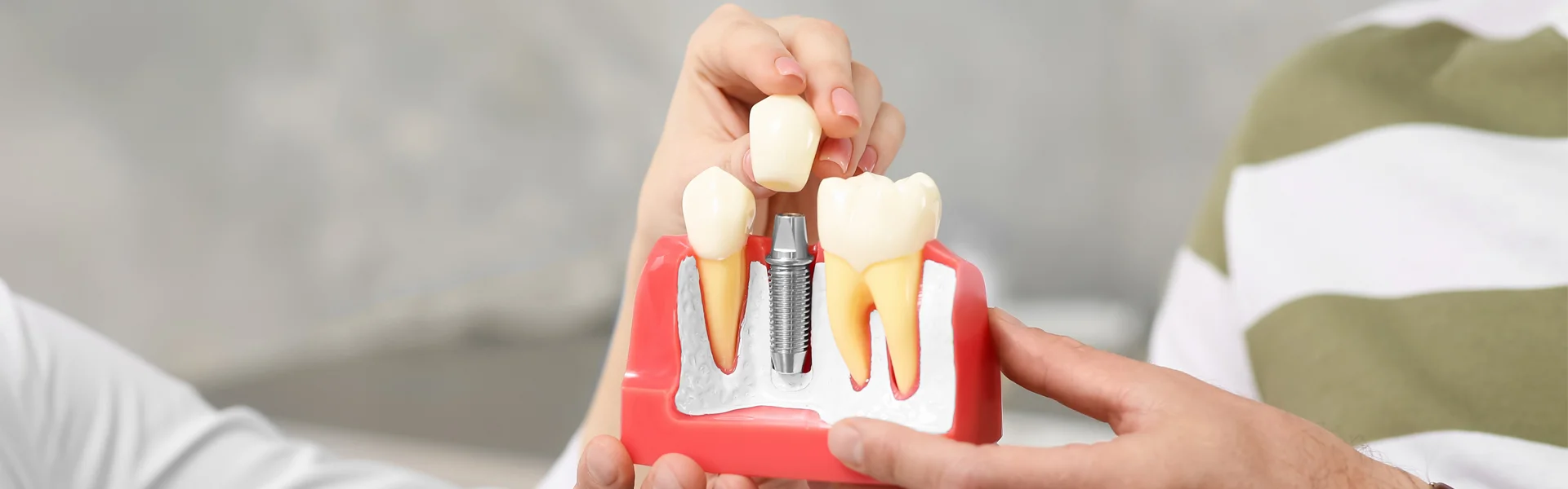 A dummy dental implants model showing how dental implants in Ajax, ON are done.