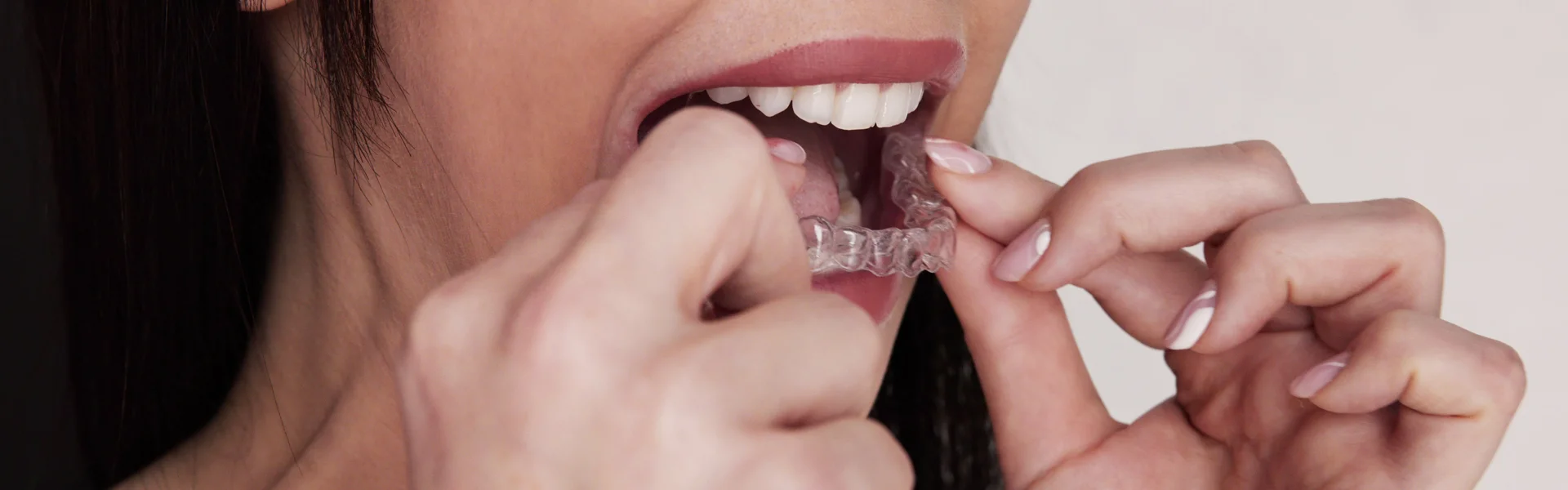 Introduction to Sure Smile Aligners