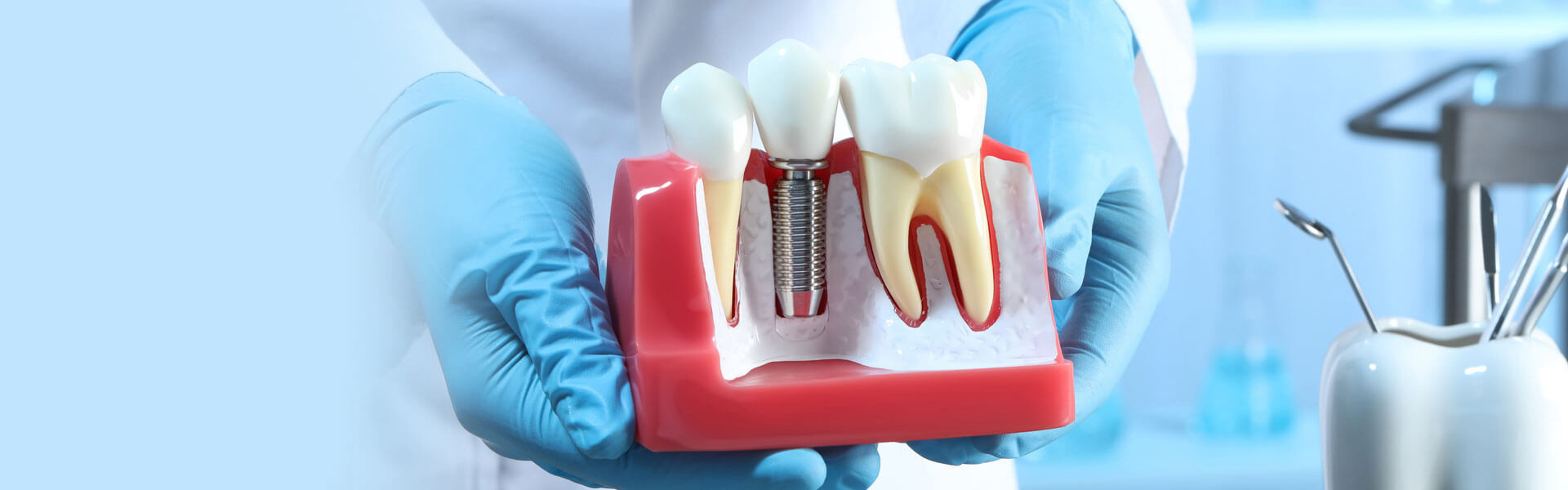 Model showing how dental implants in Ajax, ON, are done.