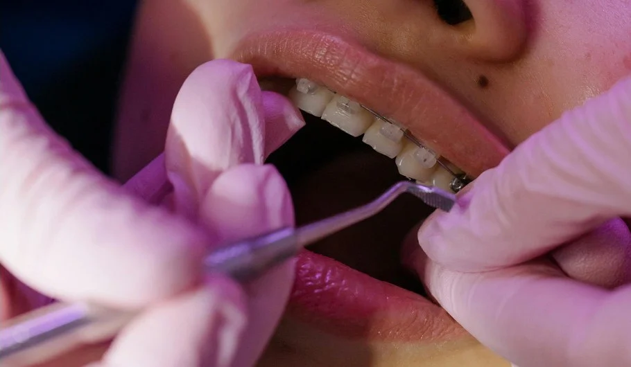 How Long Does It Take for a Teeth Cleaning and What to Expect During the Procedure at West 17 Avenue Dental