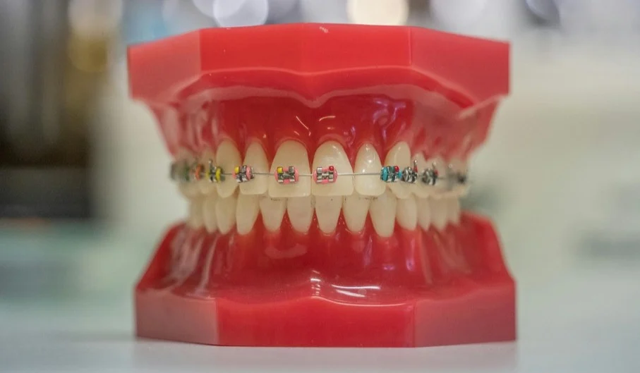 dental braces at West 17 Avenue Dental