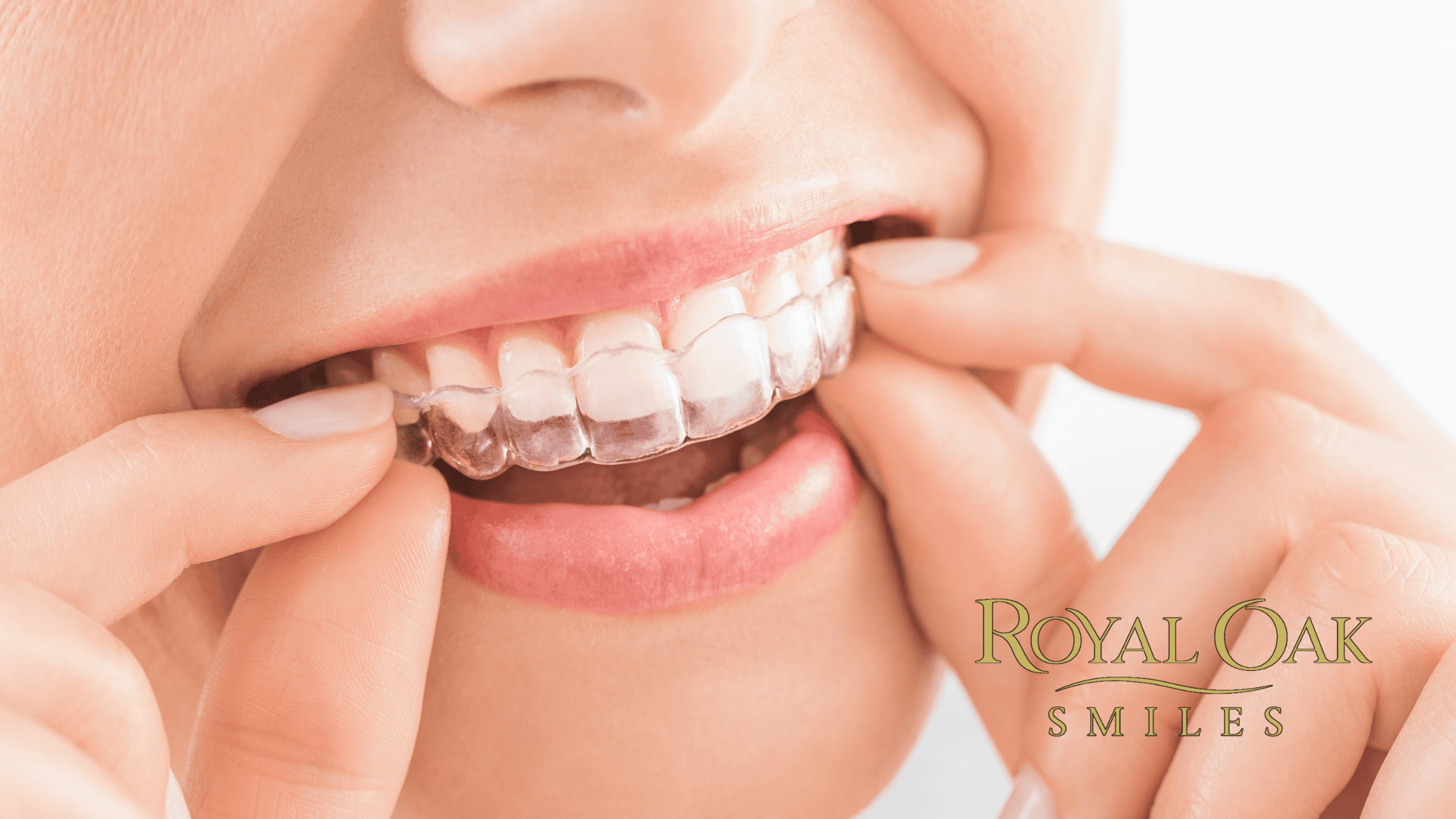 The Role of Clear Aligners in Cosmetic Dentistry