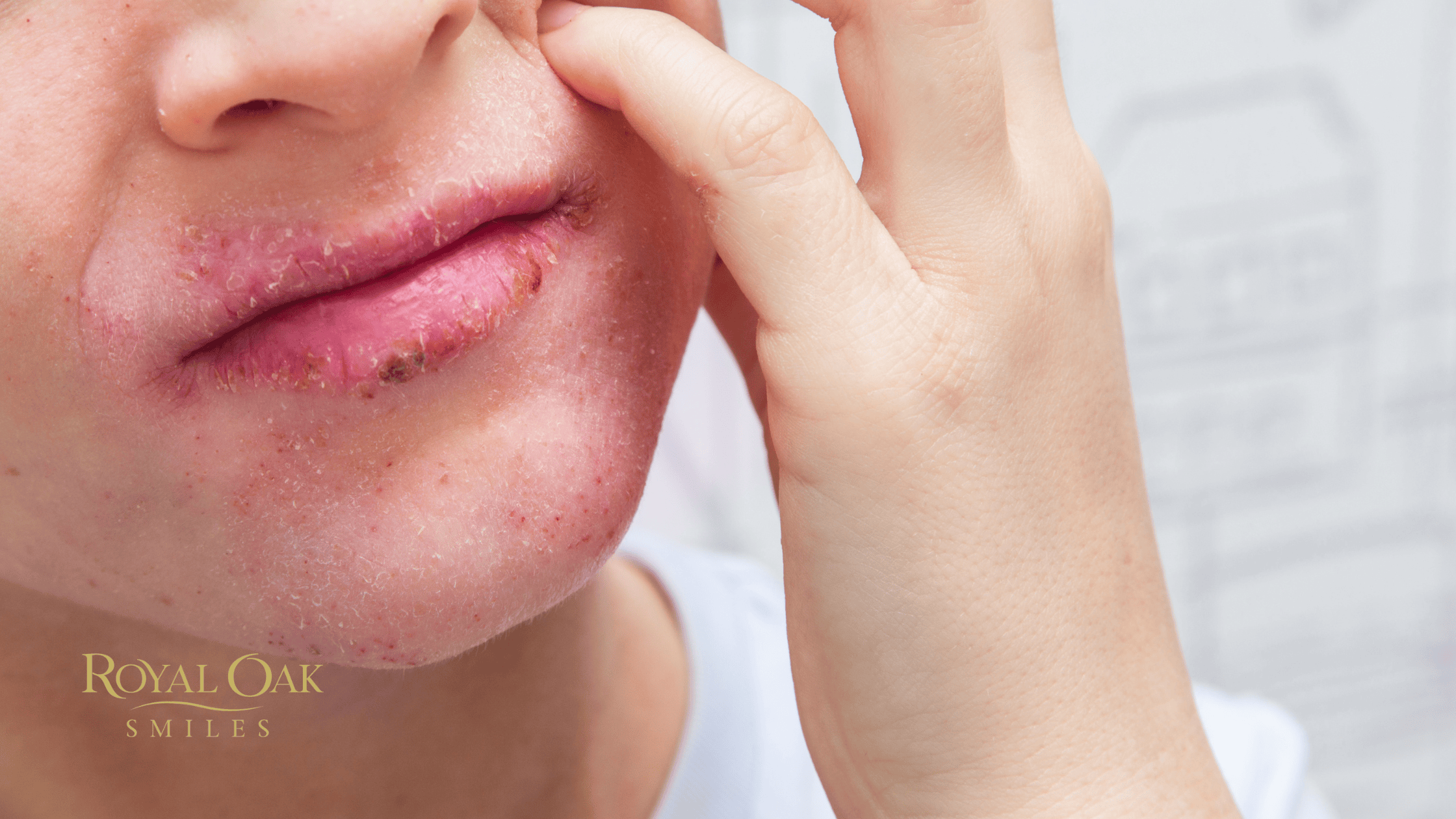 How to Recognize an Allergic Reaction to Dental Materials