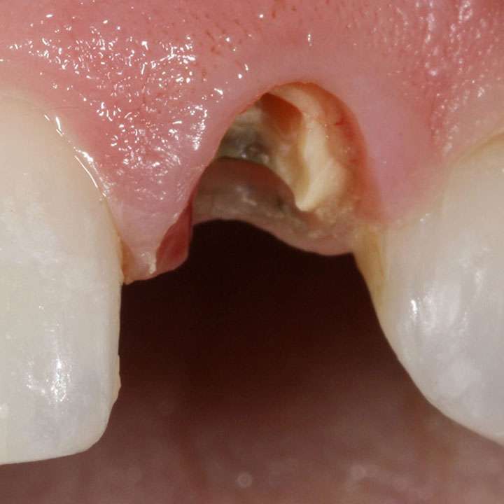 Ways to Extract Broken Root Tips