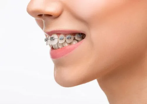 overbite
