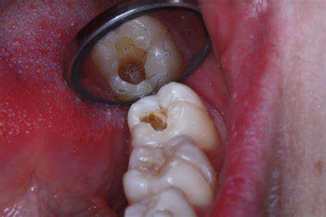 Cavities