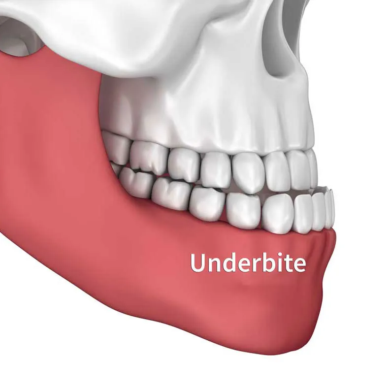 Underbite