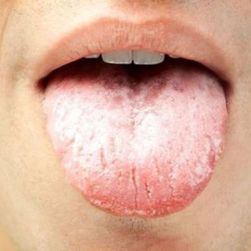 Oral Thrush