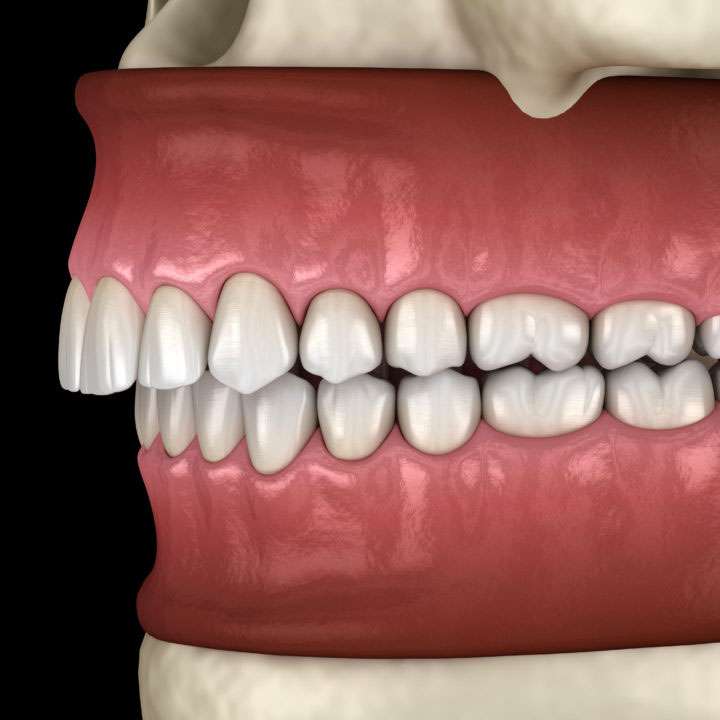 orthodontic treatment for deep bite