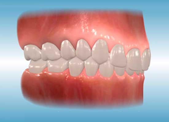 orthodontic treatment for deep bite