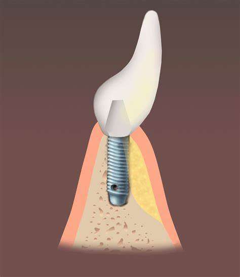 Understanding Bone Grafting for Dental Implants