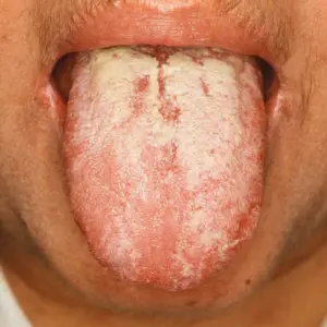 Hydrogen Peroxide and Oral Thrush