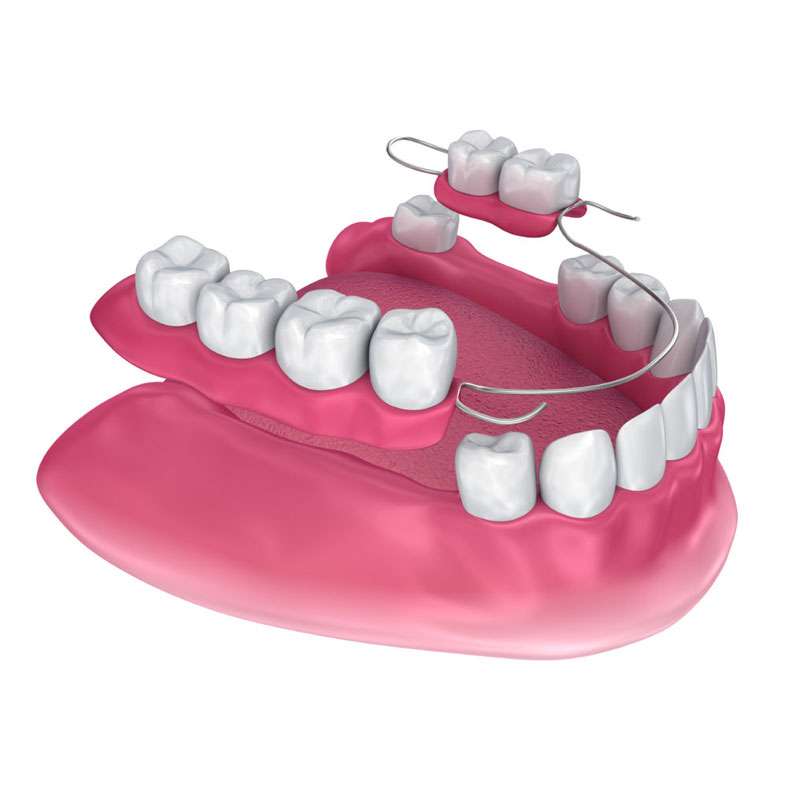 Types of Dentures